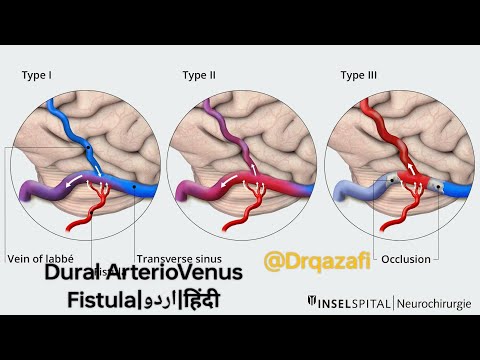 dural arteriovenous fistula (DAVF) diagnosis treatment outcome|हिंदी में|اردو میں