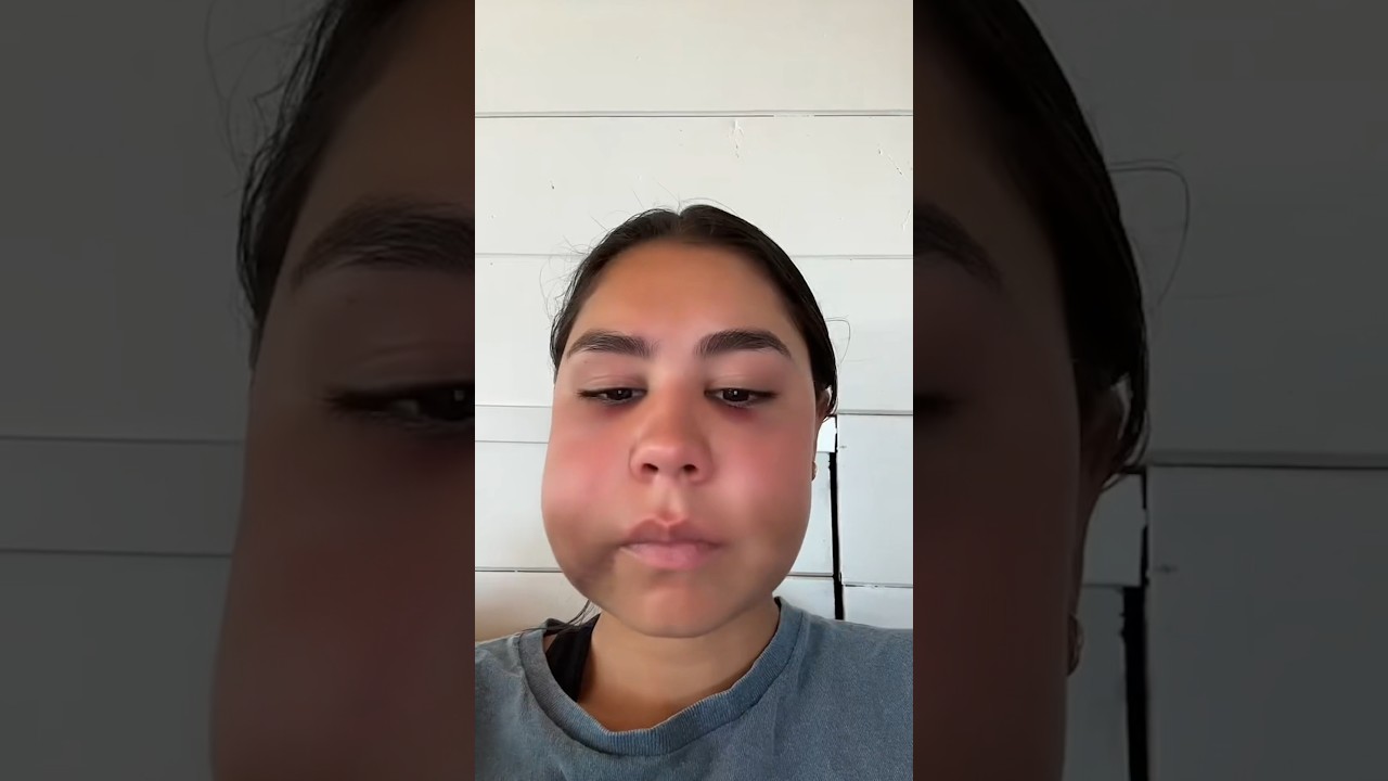 When Wisdom Teeth Go WRONG