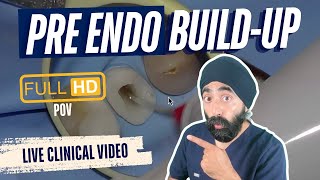Pre-Endodontic Build Up FULL HD CLINICAL Walkthrough