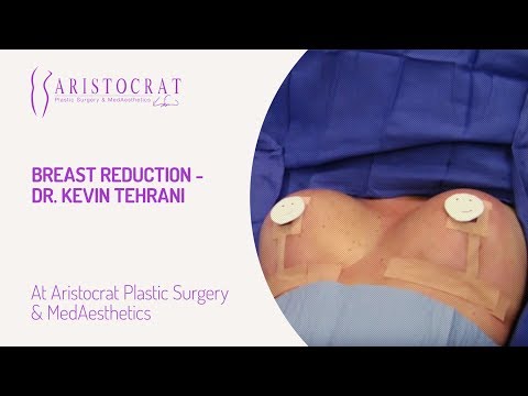 Breast Reduction- Dr. Kevin Tehrani