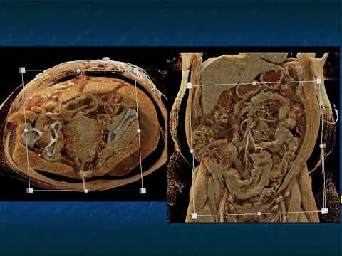 CT Evaluation of Small Bowel Obstruction: Pearls and Pitfalls in Clinical Practice - Part 4