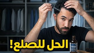 هل المينوكسيديل حل فعّال لتساقط الشعر ؟