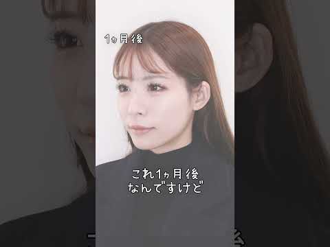 大人気レースクイーンもDr.森指名で自然で可愛いバブみある卵型小顔美人に???