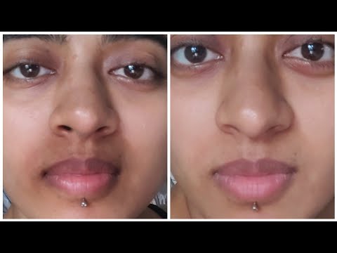 How I ACTUALLY got Rid of Pigmentation Around my Mouth...