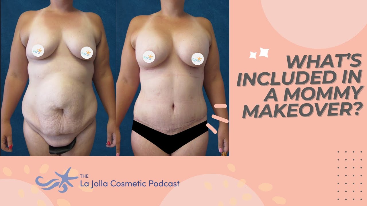 Mommy Makeover Explained by a Plastic Surgeon (and Mom)