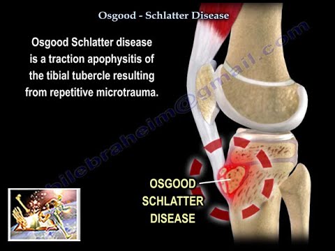 Morbus Osgood-Schlatter – Alles, was Sie wissen müssen – Dr. Nabil Ebraheim