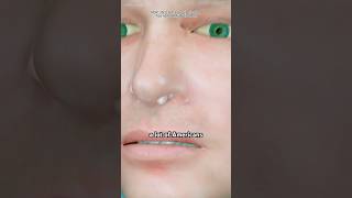 Balloon Sinuplasty Procedure - To Open Blocked Sinus Passages(3D Animation)