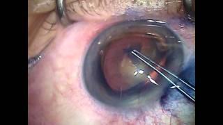 Cirurgia de catarata pela técnica de facoemulsificação