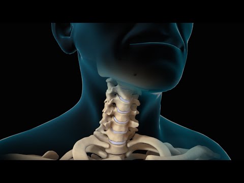 Видео: История пациента о восстановлении после операции на шее