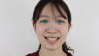 Midline Correction - Midline Correction in Orthodontics