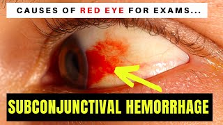 Causes of Red Eye - Part 1: SUBCONJUNCTIVAL HAEMORRHAGE (blood on the eyeball)
