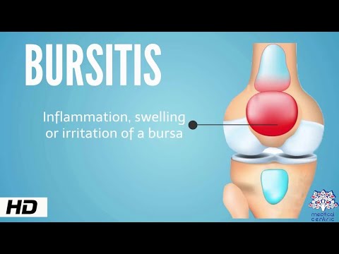Bursitis és a vállízület kezelésének szinovitisz