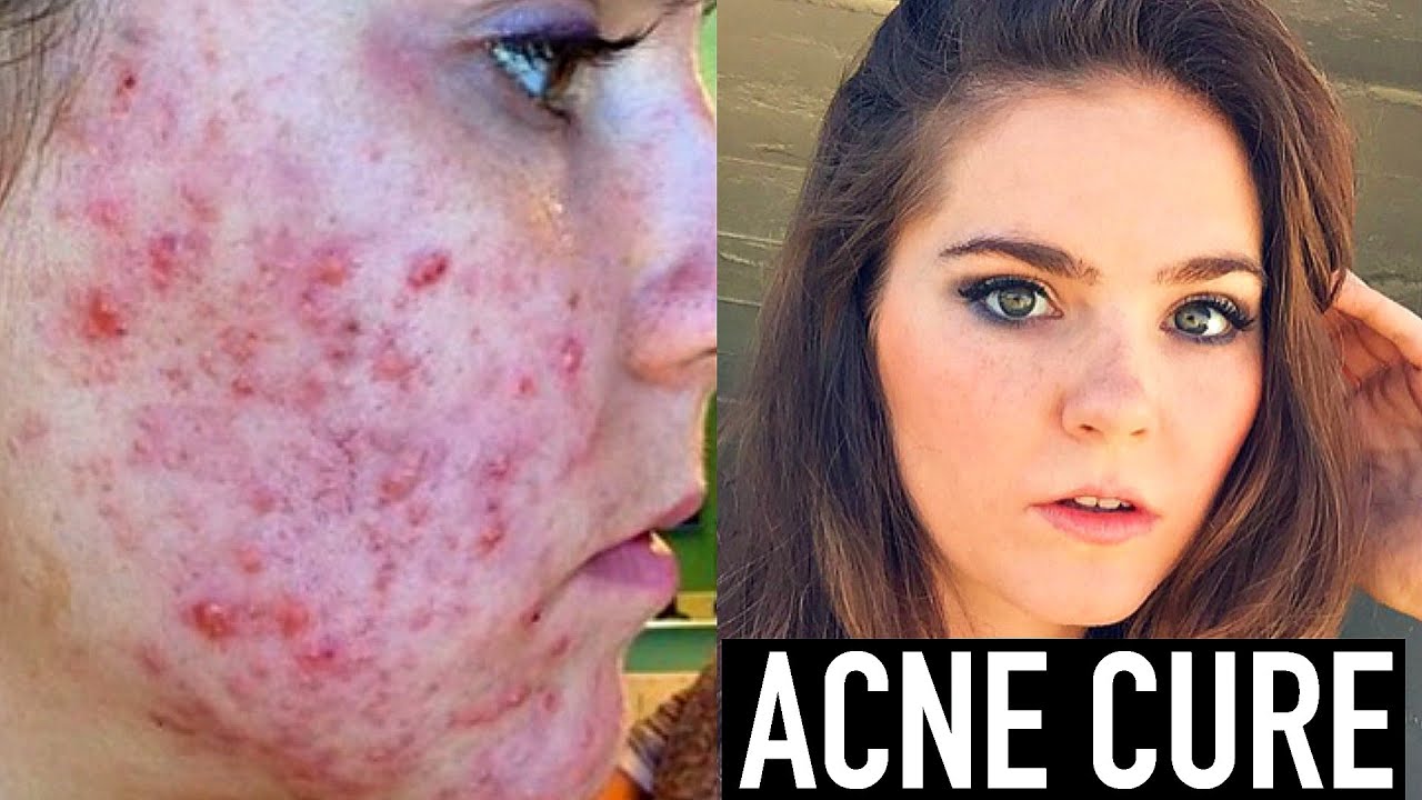 Acne Scar Treatment – Some Tips and Tricks for Light Scarring (7:17)
