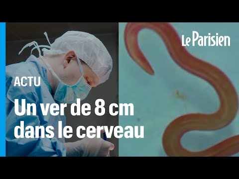 Un ver de 8 cm découvert « vivant et se tortillant » dans le cerveau d’une Australienne