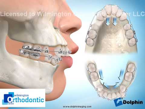 Four-bicuspid Extraction Upper 1st Lower 2nd