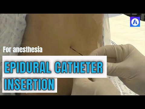 Epidural catheter insertion