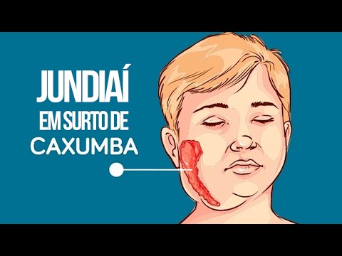JUNDIAÍ EM SURTO DE CAXUMBA!