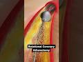 Grinding Plaque From Coronary Arteries 3D Animation