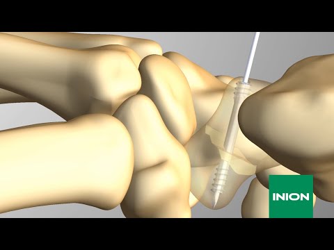 Inion CompressOn™ Bioabsorbable Screw -  Surgical Technique Animation