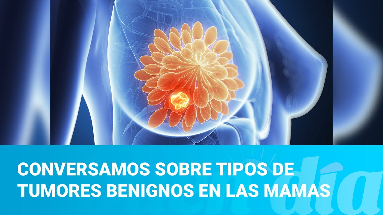 Conversamos sobre tipos de tumores benignos en las mamas