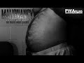 Malignancy An Ideal Host Short