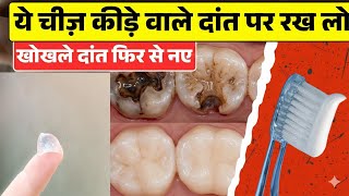 दाँतों में कीड़े? सड़न? दर्द? बस 1Tooth-Paste करके देखो - चमत्कार जैसा फर्क |Tooth Decay Treatment