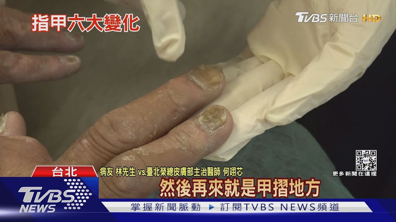 注意！ 指甲出現「這幾種」徵狀　醫：冒黑條紋恐癌症找上門