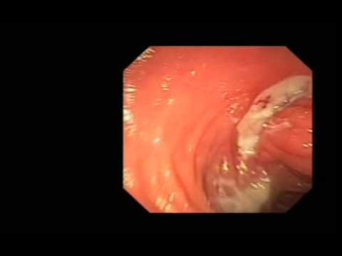 Intestin grêle, anatomie altérée après la chirurgie, ulcère et tissu de granulation après le retrait d'un stent