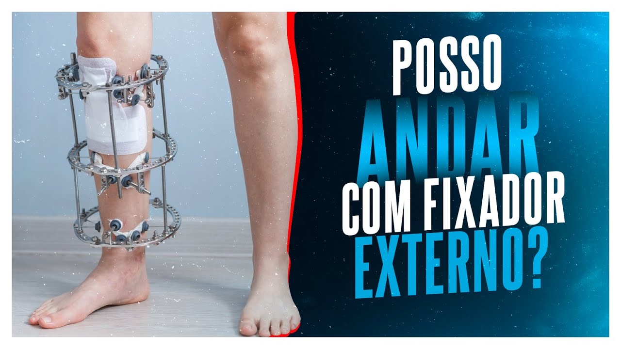 POSSO ANDAR COM FIXADOR EXTERNO - Dr. Américo Barbosa