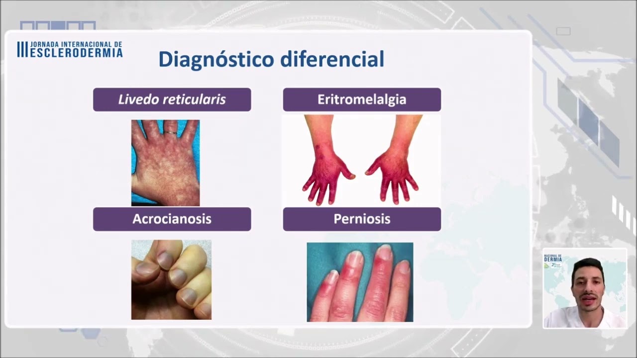 Fenómeno de Raynaud | Dr. Alfredo Guillén