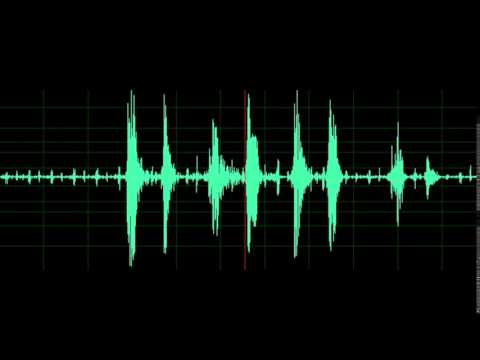 Rhonchi (In Patient with Uremic Pericarditis)