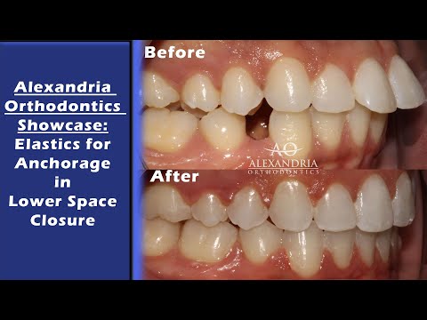 Alexandria Orthodontics Showcase:  Elastics for anchorage in lower space closure