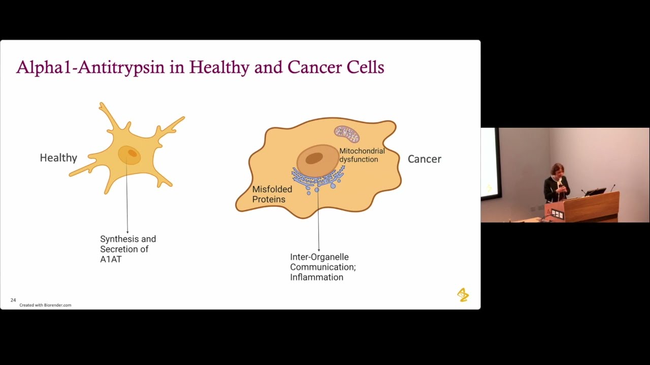 NGBS2023: Integrated analysis of N-glycoproteomic and global proteomic of glioblastoma - Sonja Hess