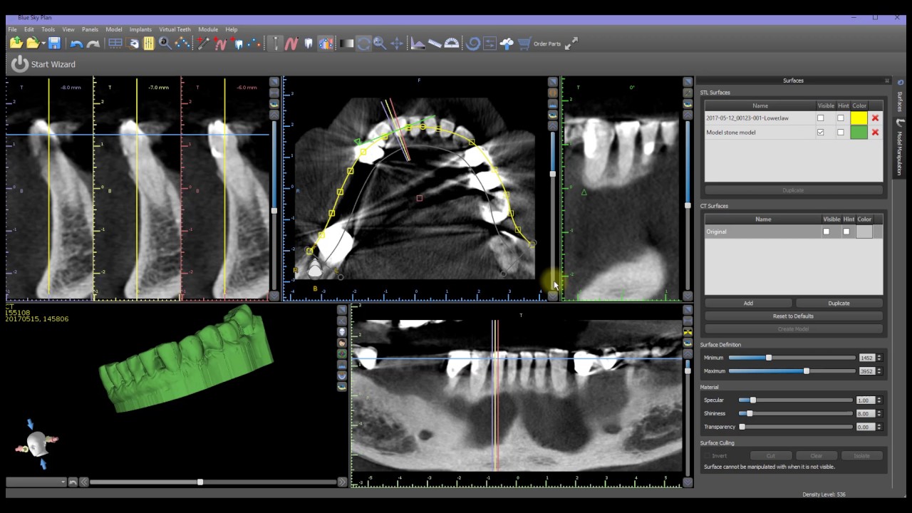 Tooth Extraction using cut Functionality in Blue Sky Plan