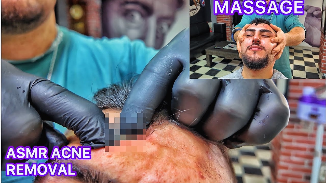 ASMR ACNE REMOVAL SATİSFYİNG VİDEO AND BARBER MASSAGE | PİMPLES REMOVAL ON FACE AT