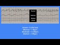 Electronic Fetal Monitoring (EFM) Basics: External & Internal Methods Explained
