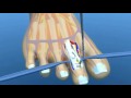 Hammer Toe Surgery Explained Podiatry Claw Toe ...