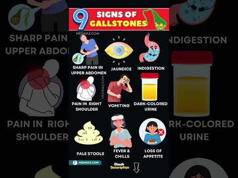 10 Early Signs of Gallstones – Don’t Miss These Symptoms!