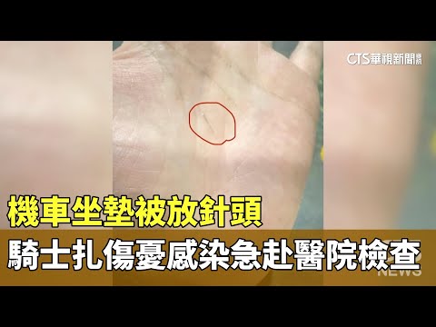 機車坐墊被放針頭　騎士扎傷憂感染急赴醫院檢查