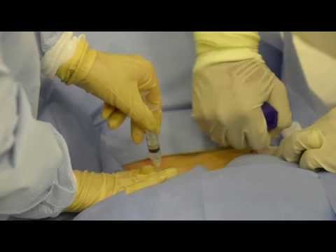 Plazmolifting az artrózis kezelésében