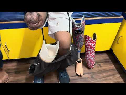 Carbon fiber prosthetics foot