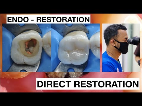 Endo Resto Dental Filling Composite Direct Restoration Upper Molar