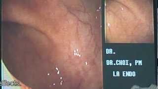 1 Minute Colonoscopy | Los Angeles Colonscopy