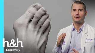 Dr.Brad remueve juanete del tamaño de una pelota de golf | Los pies me están matando | Discovery H&H