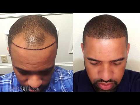 African American Hair Transplant - Before and After...