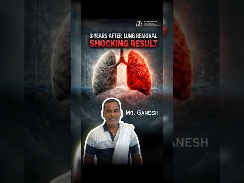 Can life be normal after one lung removal? A patient lives healthy even after 3 years.