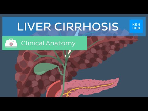 Liver cirrhosis: Definition, pathology, diagnosis, treatment and prevention | Kenhub