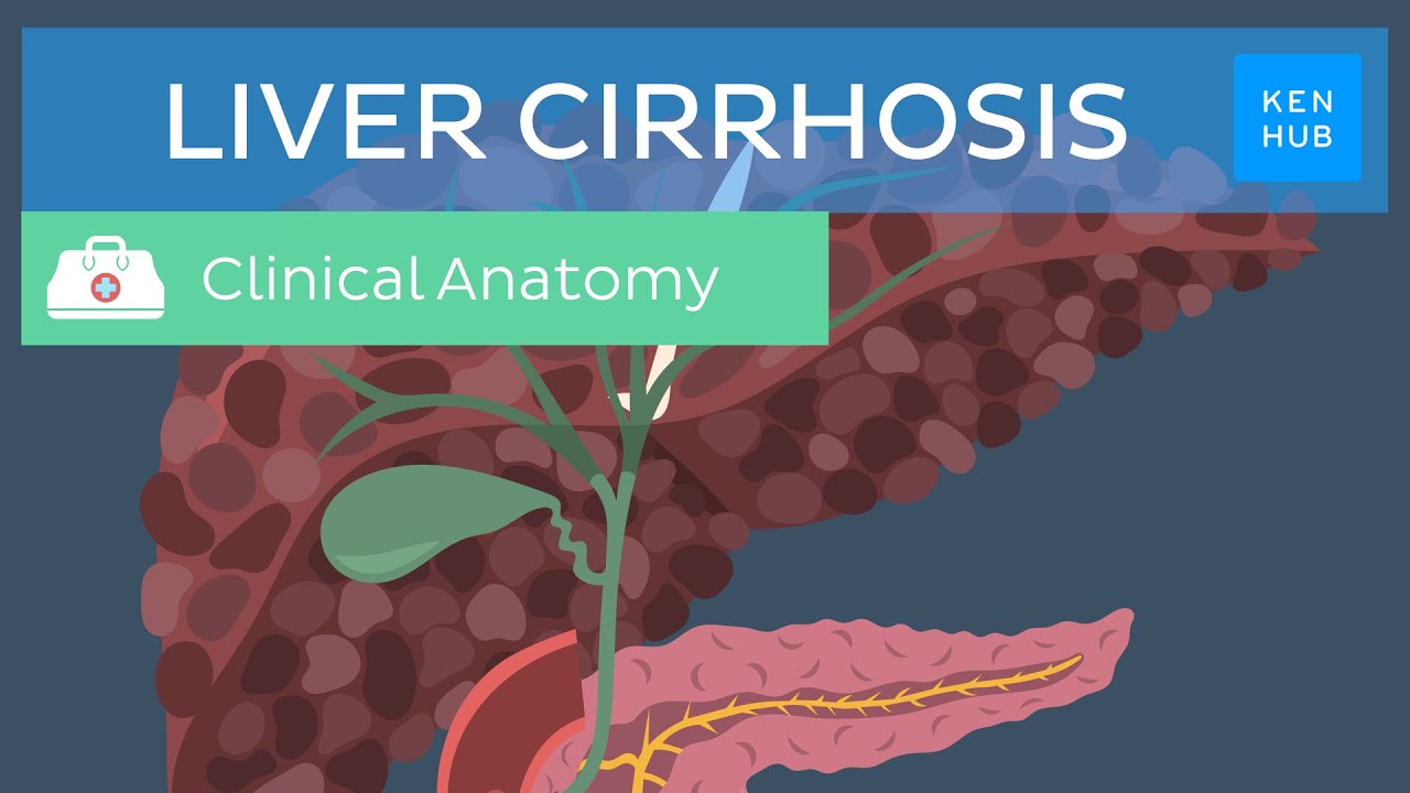 Liver cirrhosis: Definition, pathology, diagnosis, treatment and prevention | Kenhub