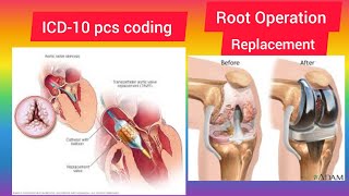 ICD-110 PCS coding training- Root operation- replacement