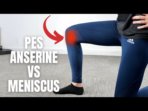 Knee Pain: Secrets of Pes Anserine Bursitis & Medial Meniscus Tear